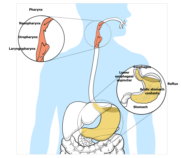 silent reflux symptoms